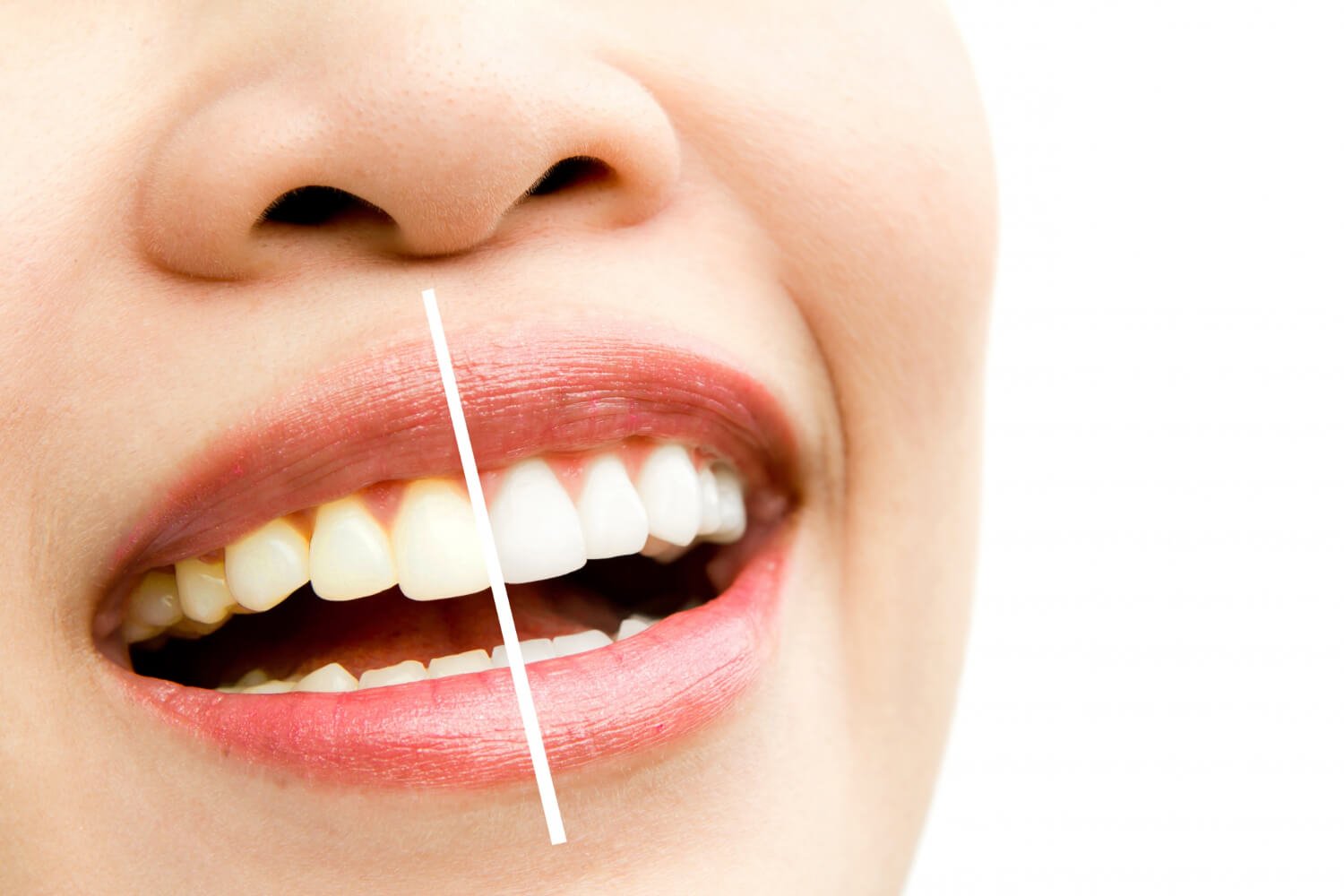 Clareamento dental Portão